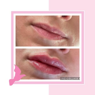 Visage Aesthetics - Chorley - Client Example of Fillers 1