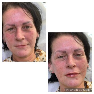 Visage Aesthetics - Chorley - Client Example of Fillers 2