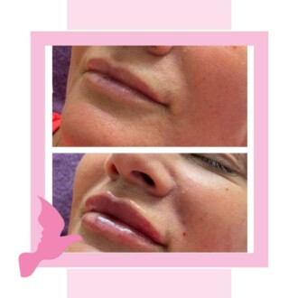 Visage Aesthetics - Chorley - Client Example of Fillers 3