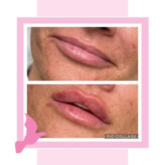 Visage Aesthetics - Chorley - Client Example of Fillers 4