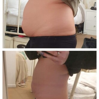 Visage Aesthetics - Chorley - Fat Dissolving 1