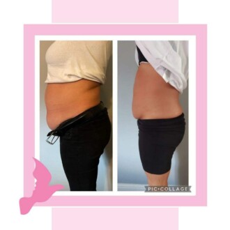 Visage Aesthetics - Chorley - Fat Dissolving 3
