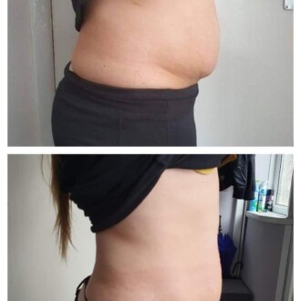 Visage Aesthetics - Chorley - Fat Dissolving 2