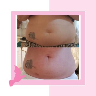 Visage Aesthetics - Chorley - Fat Dissolving 4