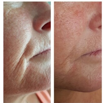 Visage Aesthetics - Chorley - Plasma Pen 2
