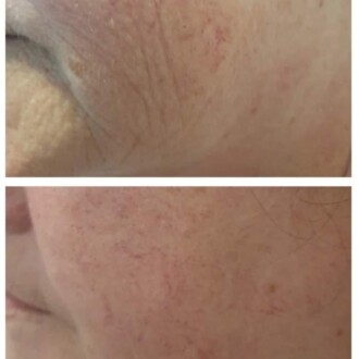 Visage Aesthetics - Chorley - Plasma Pen 3