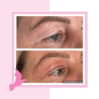 Visage Aesthetics - Chorley - Plasma Pen 4
