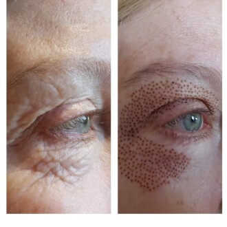 Visage Aesthetics - Chorley - Plasma Pen 5