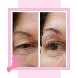 Visage Aesthetics - Chorley - Plasma Pen 6