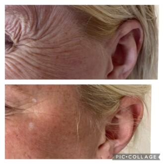 Visage Aesthetics - Chorley - Botox 4