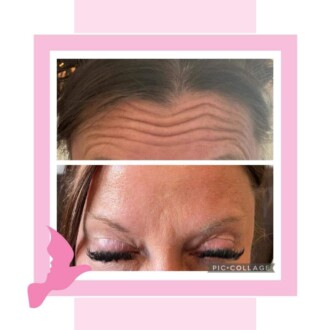 Visage Aesthetics - Chorley - Botox 3