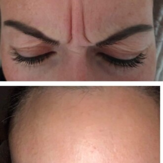 Visage Aesthetics - Chorley - Botox 2