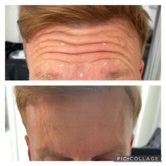Visage Aesthetics - Chorley - Botox 1